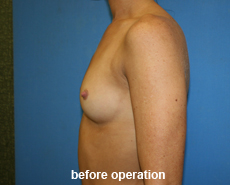 plastic-surgery-breast-augmentation